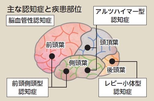 主な認知症の疾患部位を示す脳のイラスト