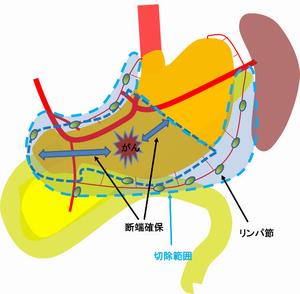 胃がん