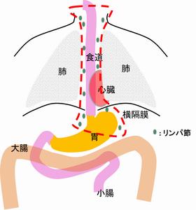 食道がん