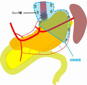 上部胃がんに対する噴門側胃切除術