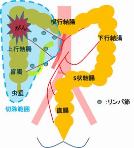 上行結腸ガン