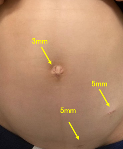 虫垂切除後の創部