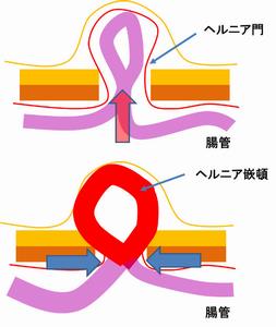 ヘルニア