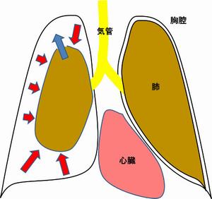 呼吸器疾患1