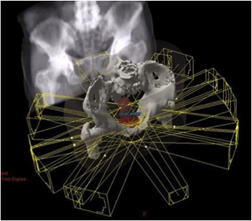骨盤の放射線治療画面の写真