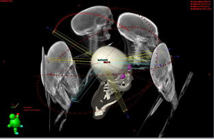 脳腫瘍に放射線治療を行っている画面の写真