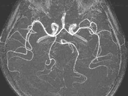 頭部のMRA