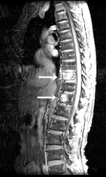 MRI画像で患部を矢印で2か所指している写真