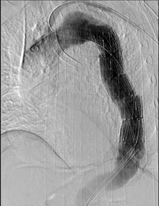 ステントグラフト挿入後の血管造影写真