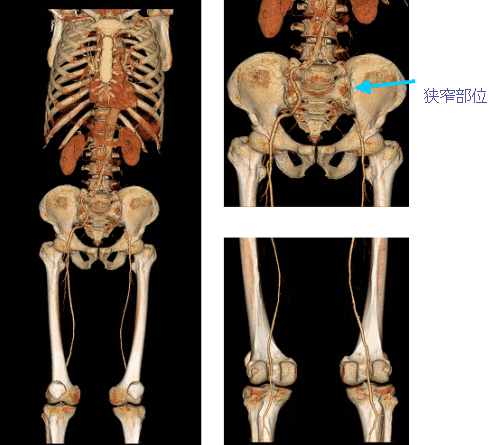 閉塞性動脈硬化症ＣＴ画像