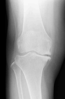 膝の正面のレントゲン写真