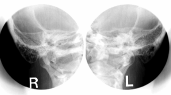 頭部右側と左側から写したレントゲン写真