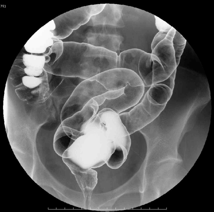 腸を撮影した造影写真