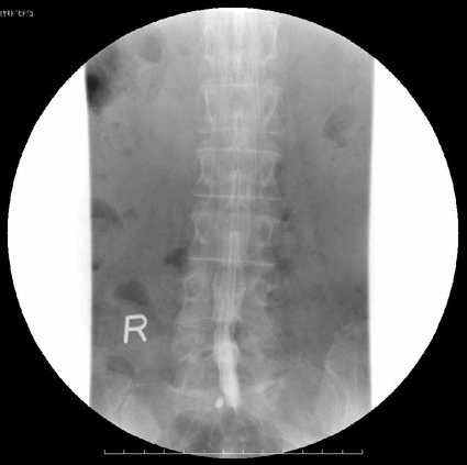 背骨の右側の造影写真